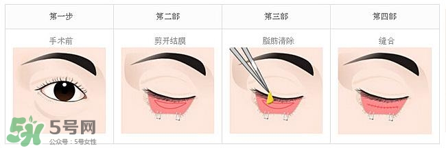 眼袋是怎么形成的？手術(shù)去眼袋安全嗎