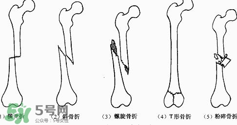 骨折吃什么好得快？骨折后注意事項(xiàng)