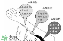 燙傷起泡要挑破嗎？燙傷起泡怎么處理？