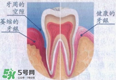 牙齦萎縮怎么辦？牙齦萎縮癥狀