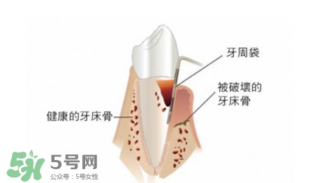 牙周炎怎么治療？牙周炎怎么治好