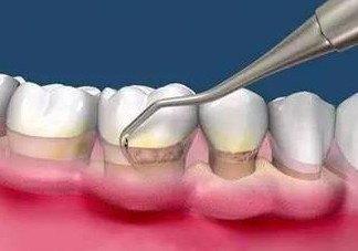 牙周炎怎么治療效果最好？牙周炎怎么治療小偏方