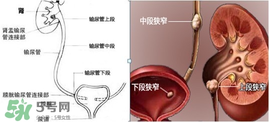 腎結(jié)石怎么治最好？腎結(jié)石的醫(yī)治方法