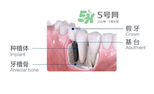 種植牙費(fèi)用多少錢？國(guó)產(chǎn)種植牙價(jià)格