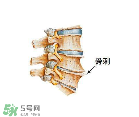 骨刺是怎么形成的？骨刺怎么治療？