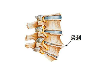 骨刺是怎么形成的？骨刺怎么治療？