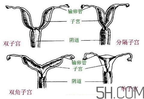 子宮畸形有哪些？子宮畸形有什么影響？