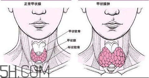 甲狀腺結(jié)節(jié)與甲狀腺腫瘤的區(qū)別有哪些？甲狀腺結(jié)節(jié)可以艾灸嗎