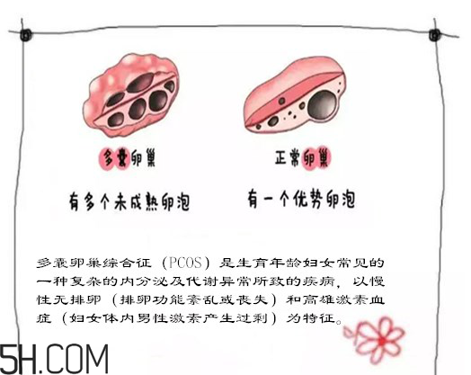 多囊卵巢生不了？多囊卵巢懷孕要看準(zhǔn)時間