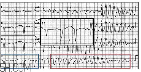 心電圖怎么看？6種常見心電圖異常情況