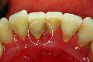 牙結(jié)石能自動脫落嗎？除了洗牙別無他法