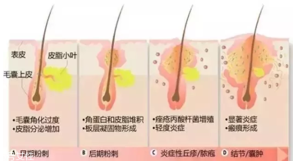 封閉性粉刺的發(fā)病機制是什么？角質(zhì)層太厚