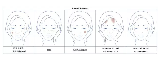 祛斑美白什么產(chǎn)品最有效 日常祛斑小妙招