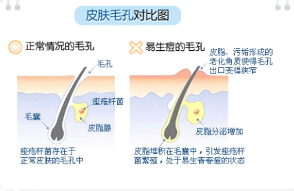 臉上長痘痘怎么快速去除 如何一天之內消除痘痘