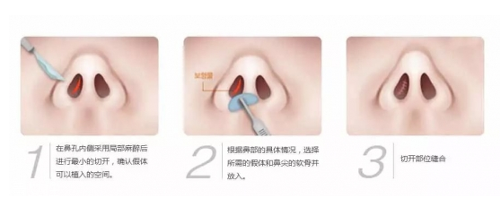 鼻子整形有幾種方法 鼻子整形哪種方法最好