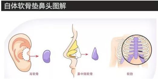 鼻子整形有幾種方法 鼻子整形哪種方法最好