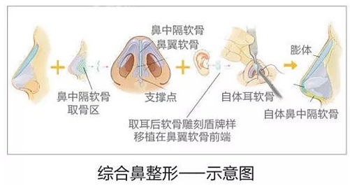 鼻子整形有幾種方法 鼻子整形哪種方法最好