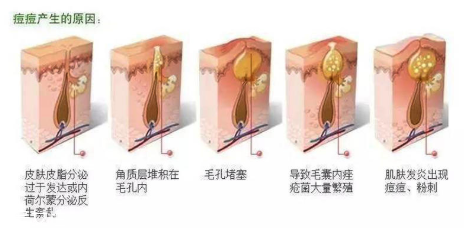 頑固痘痘怎么消除？油皮為什么反復(fù)爆痘？