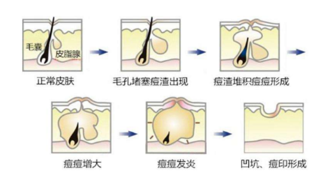 紅腫痘痘怎么快速消腫 遠離紅腫痘痘大作戰(zhàn)