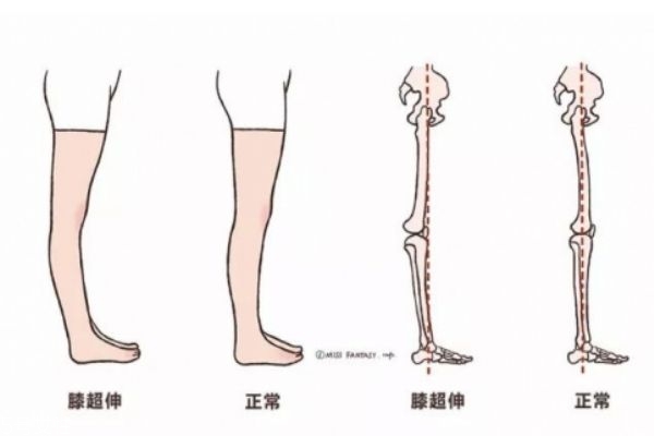 膝蓋超伸怎么矯正 如何正確處理膝超伸