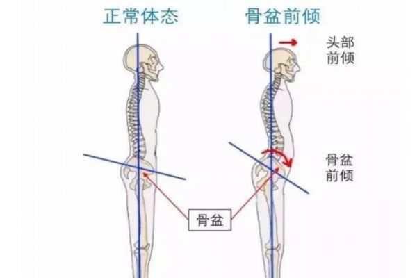 骨盆前傾的危害 3大危害你必須知道