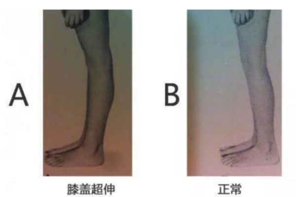 膝關節(jié)超伸的表現(xiàn) 快來自測一下把