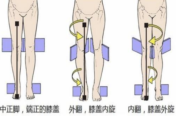 膝蓋超伸可以恢復(fù)嗎 可以通過(guò)鍛煉改善