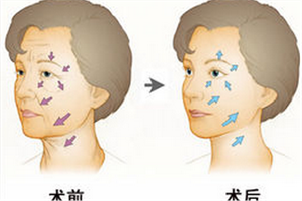 注射除皺針多少錢一針 除皺針的價格是多少錢