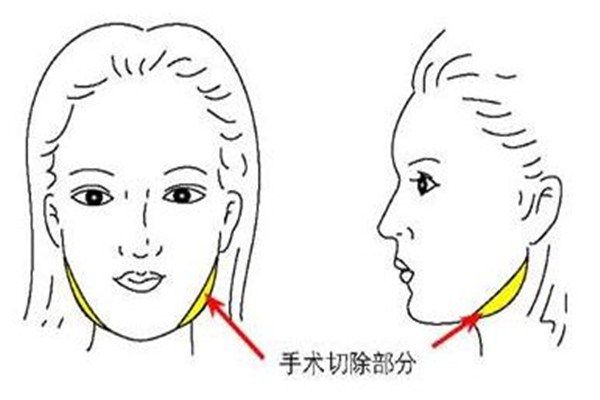 什么人適合下頜角整形手術 下頜角整形手術多久能消腫