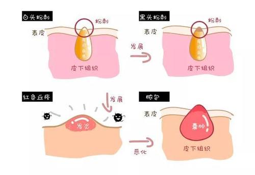 適合長(zhǎng)脂肪粒用的眼霜 長(zhǎng)脂肪粒適合用什么護(hù)膚品