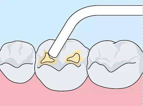 補(bǔ)牙后可以吃什么 牙齒有洞不補(bǔ)會(huì)怎樣