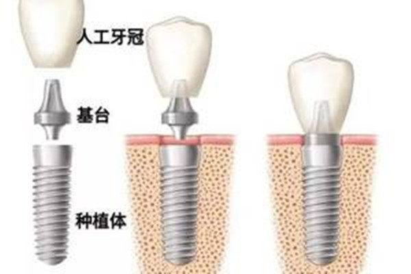 種植牙齒的好處 種植牙齒的優(yōu)點