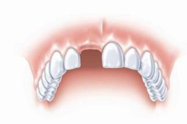 什么情況下適合種植牙齒 種植牙齒分為幾個階段