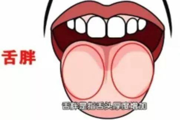 胖大舌是什么 什么情況下會出現(xiàn)胖大舌