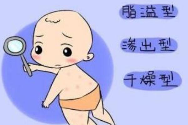 新生兒濕疹怎么治療最好的方法 新生兒濕疹是什么引起的