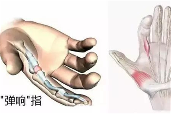 腱鞘炎對(duì)身體有什么危害 腱鞘炎對(duì)生活有影響嗎