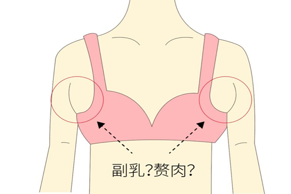 副乳怎么可以消除 副乳有什么危害嗎