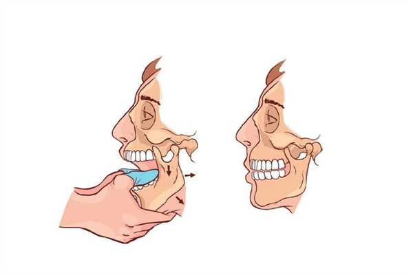 下巴脫臼怎么回事 下巴脫臼掛哪個(gè)科