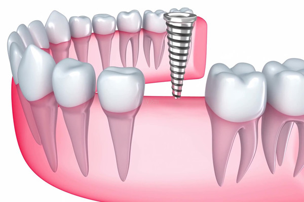 種植牙如何護(hù)理 種植牙會(huì)有后遺癥嗎