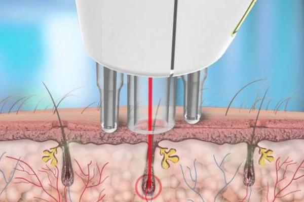 激光脫毛和冰點脫毛有什么區(qū)別 激光脫毛有什么后遺癥