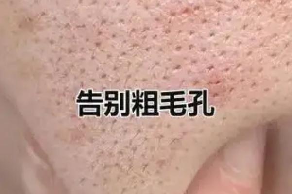 毛孔粗大怎么辦怎么收縮毛孔 毛孔粗大用什么護(hù)膚品可以改善