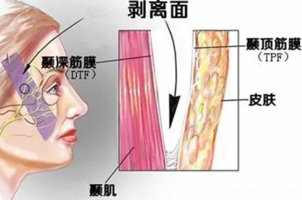 拉皮手術的疤痕多久消失 拉皮手術是全麻還是局麻