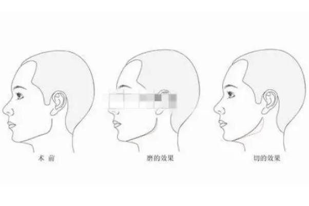 顴骨內(nèi)推的釘子需要取出嗎 顴骨內(nèi)推是幾級(jí)手術(shù)