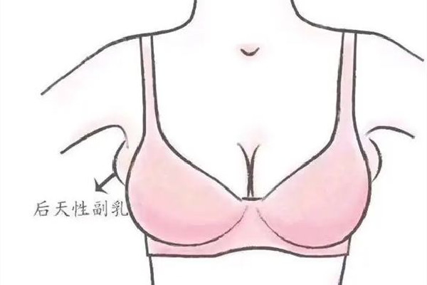 副乳切除手術是全麻還是局麻 副乳切除手術后多久可以正?；顒?></p><h3>副乳切除手術可以進醫(yī)保嗎</h3><p>副乳手術醫(yī)保能不能報銷，要看副乳腺到底是屬于什么情況，比如像病理型的副乳腺手術，副乳腺里面長了腫瘤，或者乳腺癌。這部分病人在切除腫瘤同時把副乳腺切除，這部分的費用是可以醫(yī)保報銷的。但是純粹的并沒有其他病變，為了美容目的進行副乳手術，這部分病人醫(yī)保是不予報銷的。</p><p><br/></p>		</div>
<div align=