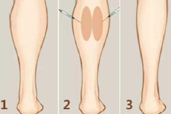 武漢打瘦腿針的醫(yī)院推薦 武漢打瘦腿針要多少錢